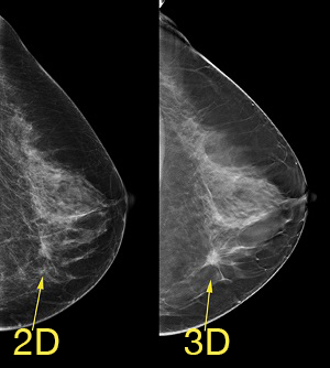 3D 乳房造影