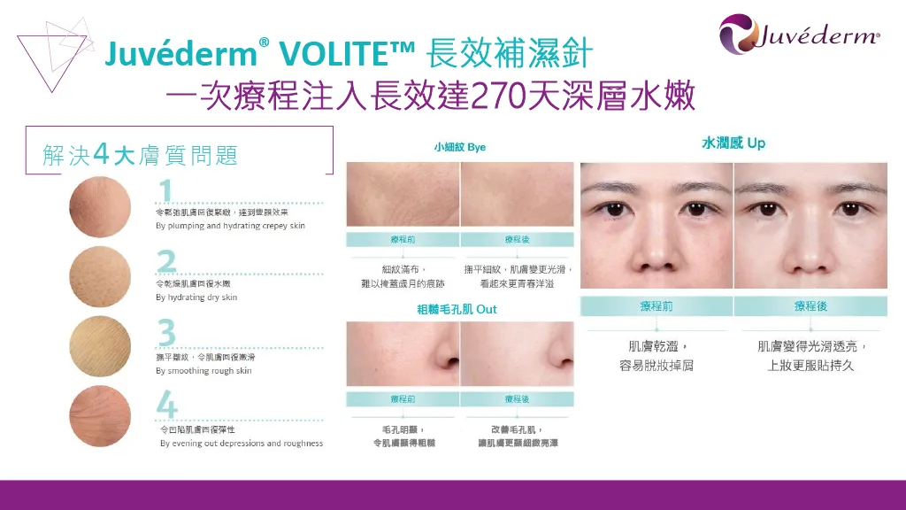 【Christmas Special Offer】 Juvéderm® Long-Lasting Hyaluronic Acid Contour Enhancement Treatments (Volite / Voluma / Volift)