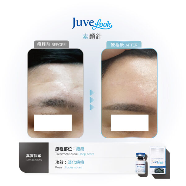 【Limited Offer】Juvelook Collagen Skinbooster