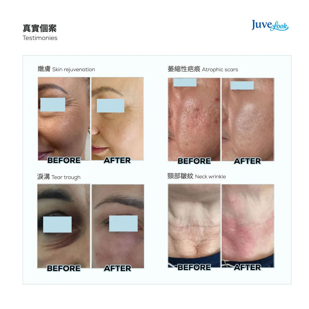 【Limited Offer】Juvelook Collagen Skinbooster