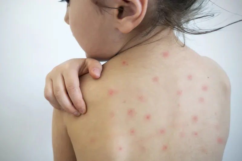 Young girl with measles virus.