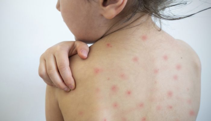 Young girl with measles virus.