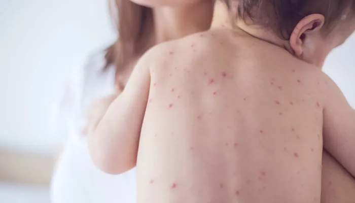 chicken-pox